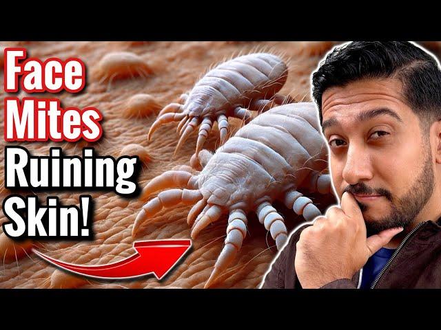 How to Get Rid of Face Mites Fast | Easy Face Mites Removal