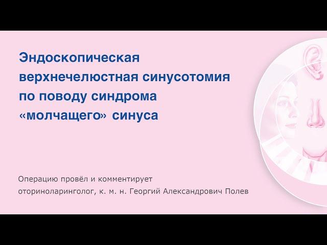 Эндоскопическая верхнечелюстная синусотомия по поводу синдрома «молчащего» синуса