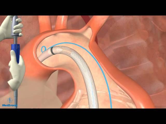 Thoracic Endovascular Aortic Aneurysm Repair in Dallas