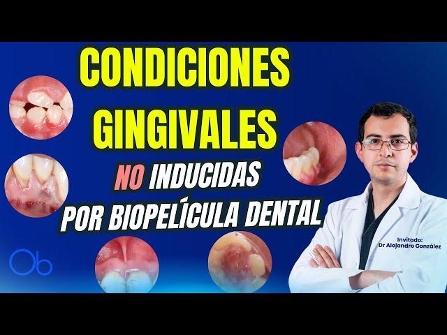 Condiciones gingivales NO inducidas por biopelícula dental con Dr Alejandro González Olacio