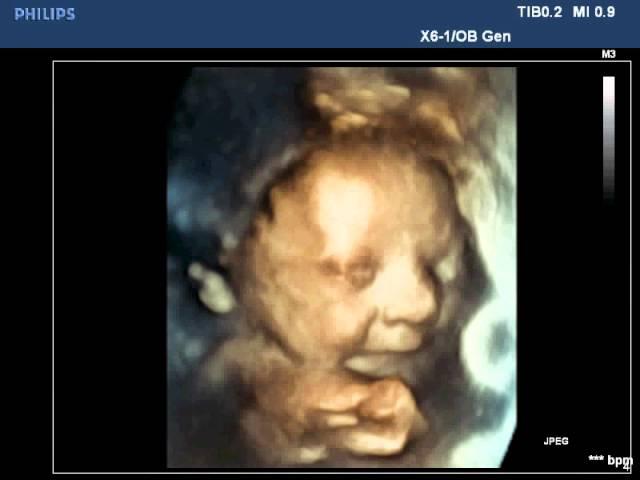 Fetal 3D Ultrasound - smiling baby