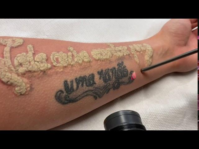 Detatouage Laser, Tattoo removal Laser