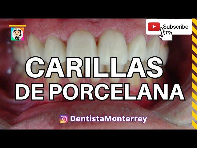 ⏭️CARILLAS de PORCELANAQuickVideo #CarillasDentales