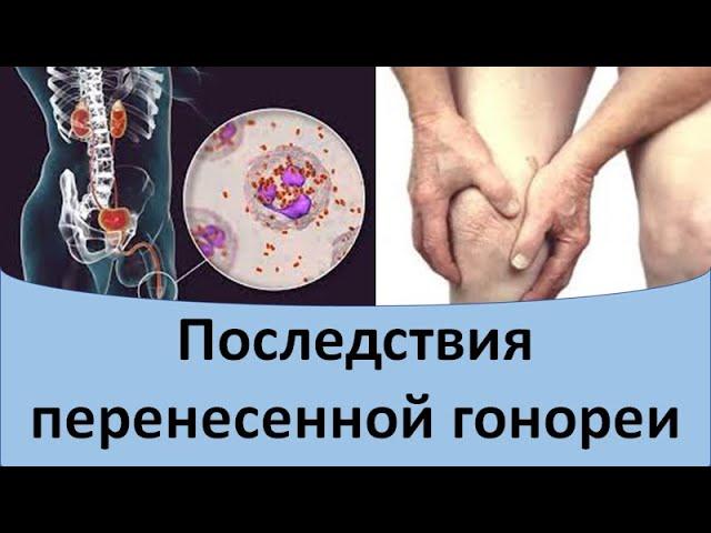 Последствия гонореи