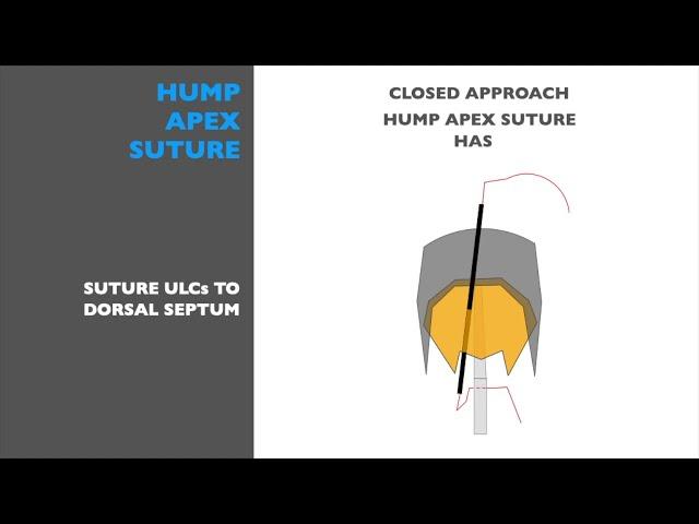 HUMP APEX SUTURE - Miguel Gonçalves Ferreira, MD, PhD