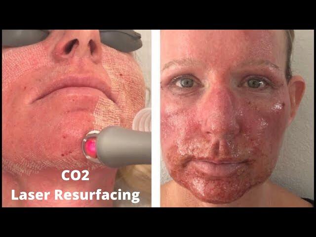 CO2 Laser Resurfacing ~ CO2RE