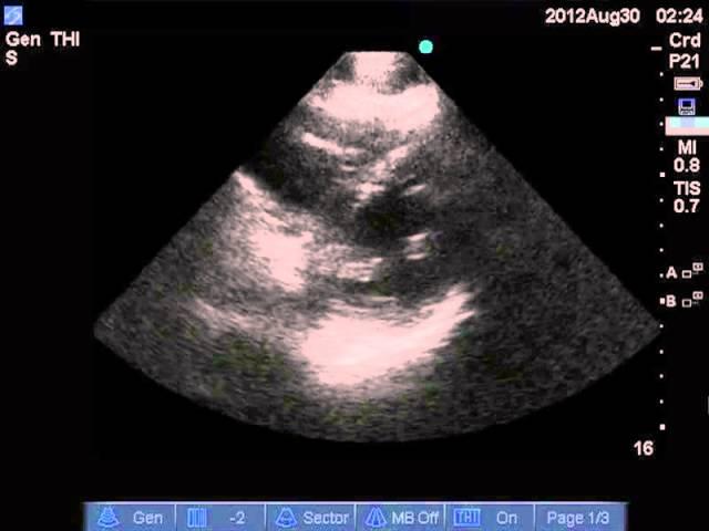 Early Septic Shock - Parasternal Short Axis