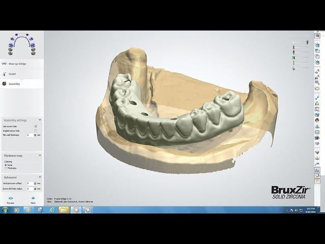 CAD/CAM Tools Tips & Tricks BruxZir Full-Arch Implant Prosthesis Design (Vol. 1, Issue 3)