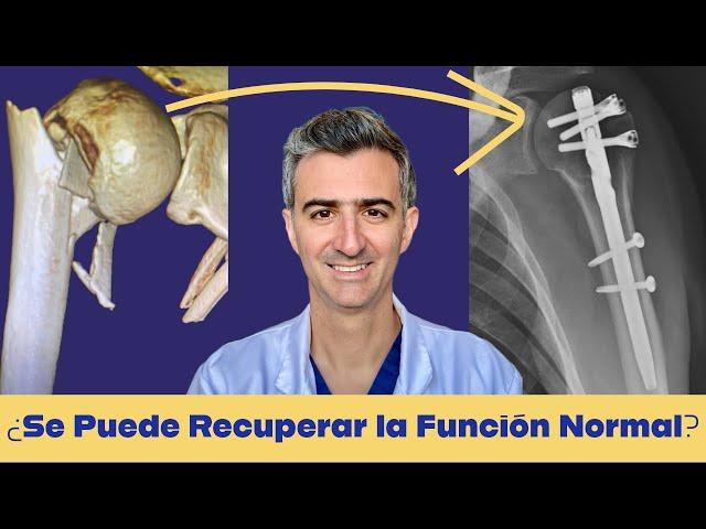 Tratamiento Quirúrgico Fracturas del Húmero Proximal: ¡Guía Completa!