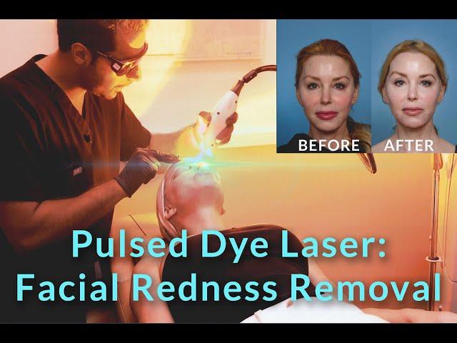 Pulsed Dye Laser: Facial Redness Removal - with Dr. Sameer Bashey | Over 50