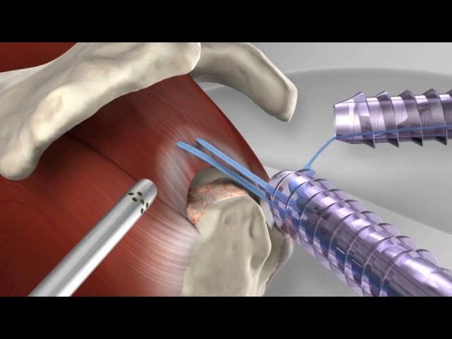 Knotless Rotator Cuff Repair with Arthrex® SpeedFix™