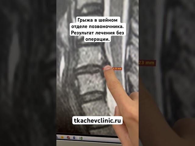 Грыжа в шейном отделе позвоночника. Результат лечения без операции. #грыжадиска #позвоночник