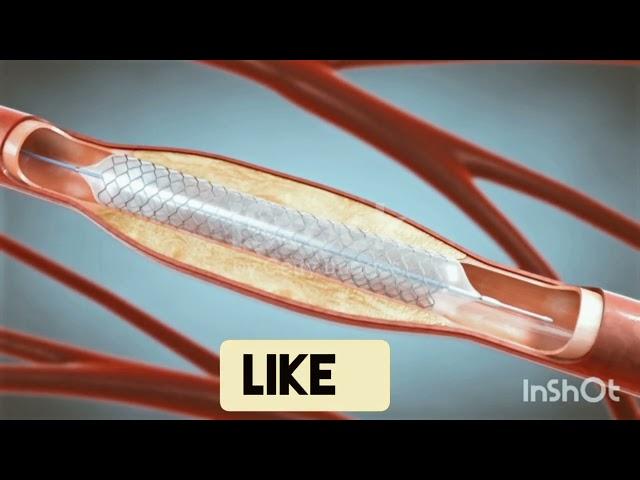 Stent implantation in blood vessels! Angioplasty! 3d animation!cornory Angioplasty! medical world!