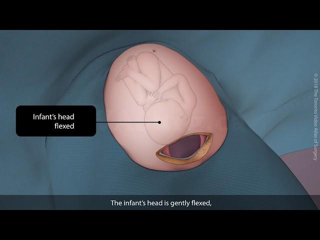 Primary vertex caesarean section (C-section) | TVASurg