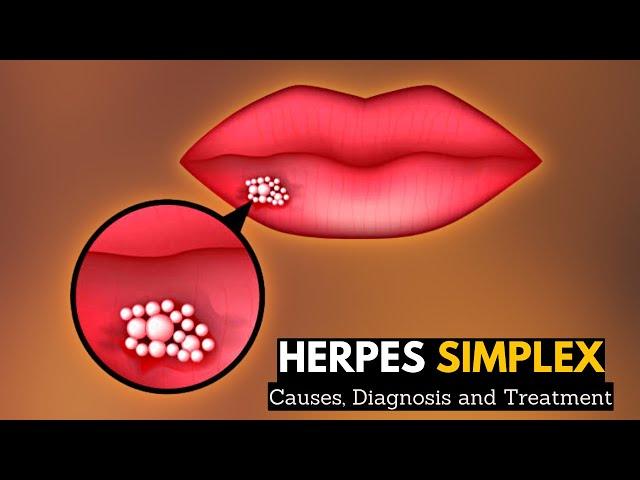 Herpes Simplex, Causes, Signs and Symptoms, Diagnosis and Treatment.