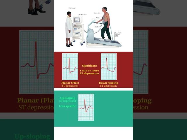 Significant ST change definition in Exercise Testing