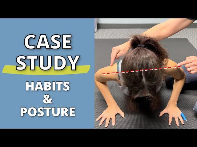 CASE STUDY: The Impact of HyperMobile Habits on Posture Long-Term #hypermobile #posture #eds