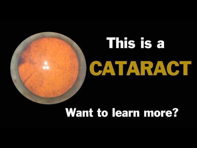 Uncovering the Mystery of Cataracts: What You Need to Know!