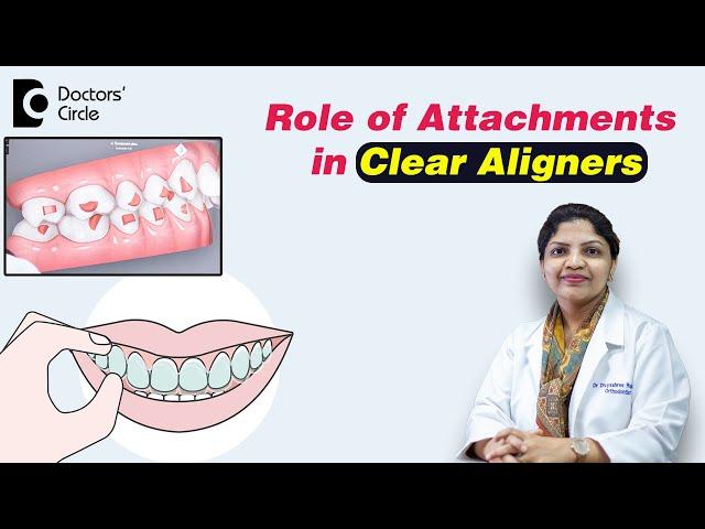 How Aligner Attachments are placed? | Button Attachments - Dr. Divyashree Rajendra | Doctors' Circle