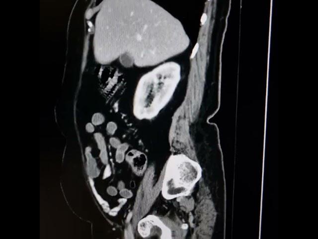 Endometrial carcinoma.