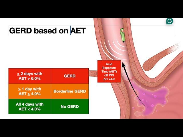 GERD - Endoscopic Evaluation - Bravo Test