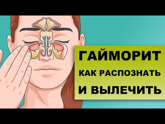 ГАЙМОРИТ. СИНУСИТЫ. Как диагностировать и лечить