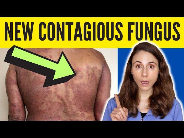 DRUG-RESISTANT CONTAGIOUS RINGWORM IN THE US 