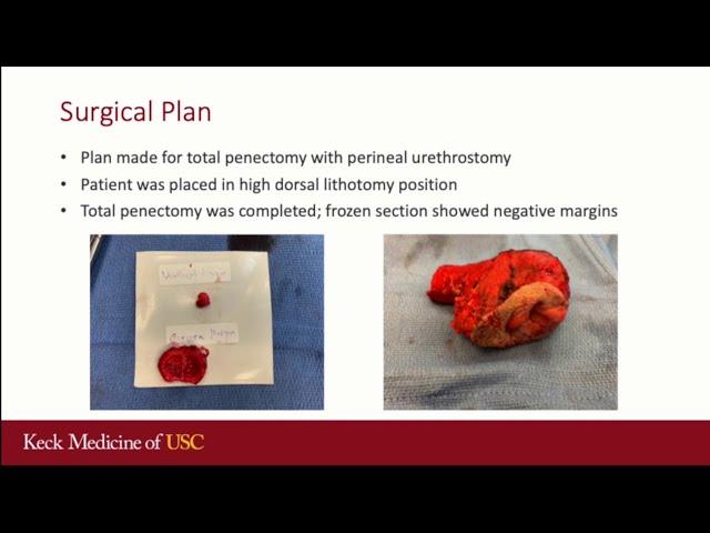 Core Videos (2020): Loop Perineal Urethrostomy Following Total Penectomy