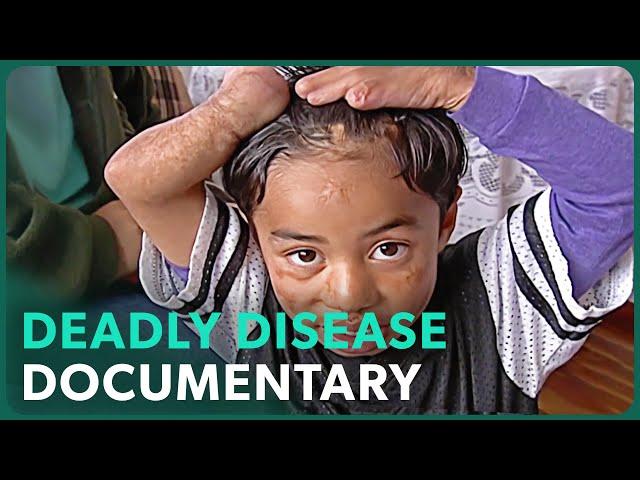 Meningitis: Search For A Cure (Medical Documentary) | Real Stories