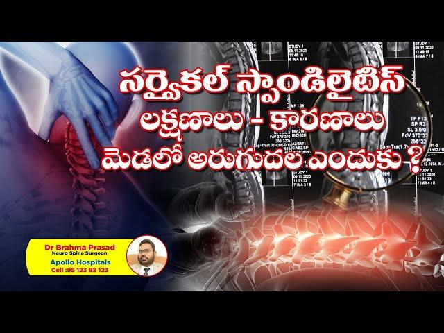 cervical spondylosis in telugu ll spondylosis  symptoms telugu ll Dr Bramha Prasad ll Neck pain