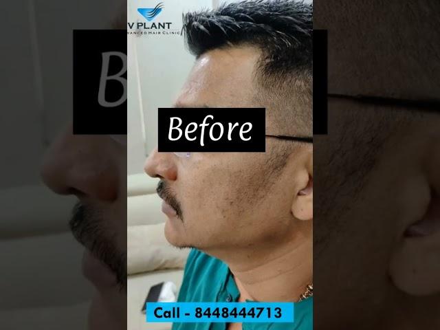 MHI Beard Transplant