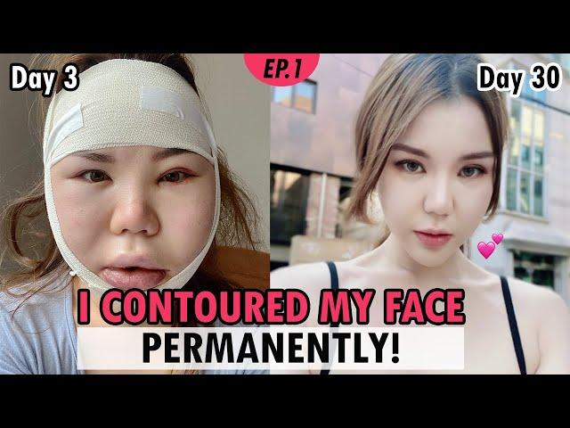 [SUB] Zygoma & Jawline Reduction in Korea | vline facial bone surgery vlog review | Recovery Results