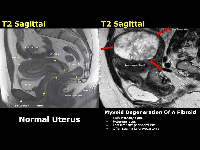 Uterus MRI Normal Vs Abnormal Images | Uterine & Cervix Pathologies | Cancer Staging | Gynecology