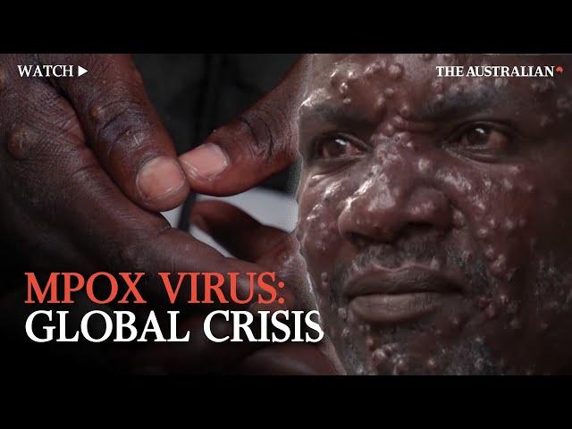 Mpox Outbreak: Understanding the global health emergency