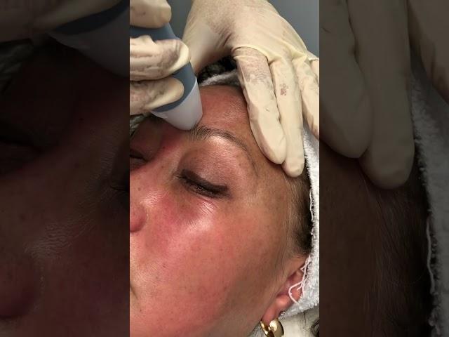 EXION RF MICRONEEDLING