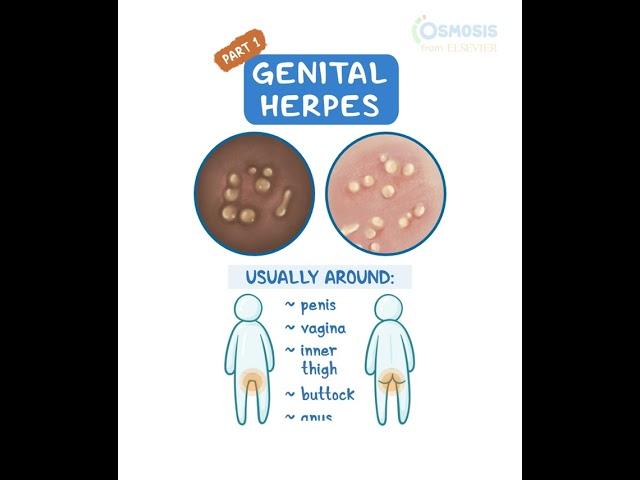 Genital Herpes