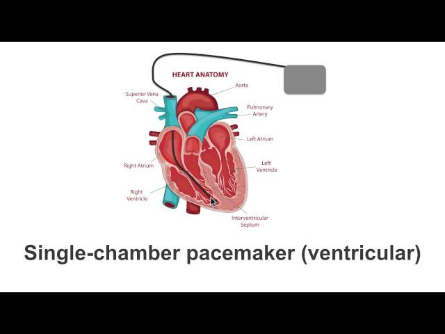 Pacemaker Varieties: Single to Biventricular Explained