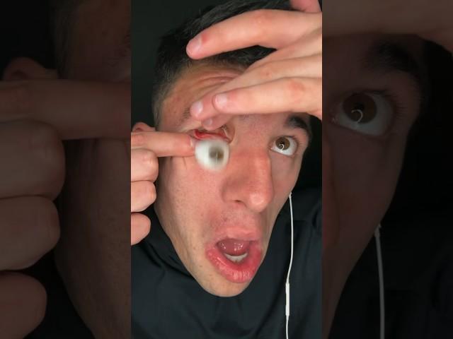 MY EYEBALL POPPED OUT 