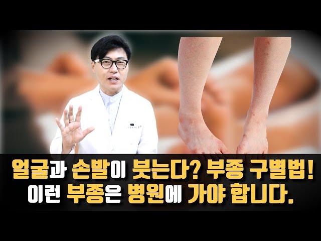 얼굴과 손발이 자주 붓는다. 부종의 원인별 대처법. 이런 부종은 병원에서 검사가 필요합니다. 반대로 이런 부종은 병원에 안가도 됩니다.