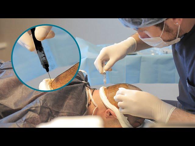 Is a Hair Transplant Painful? All Your Questions Answered | Elithair