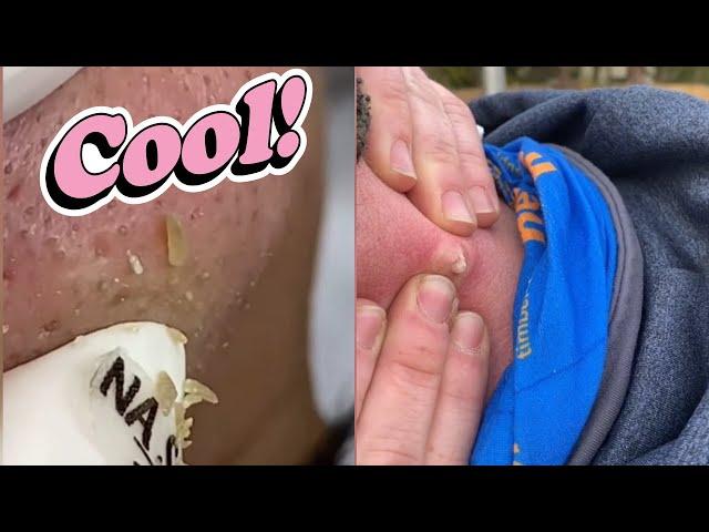Explosive Pimple Pooping!  Ultimate Pimple Popping Compilation