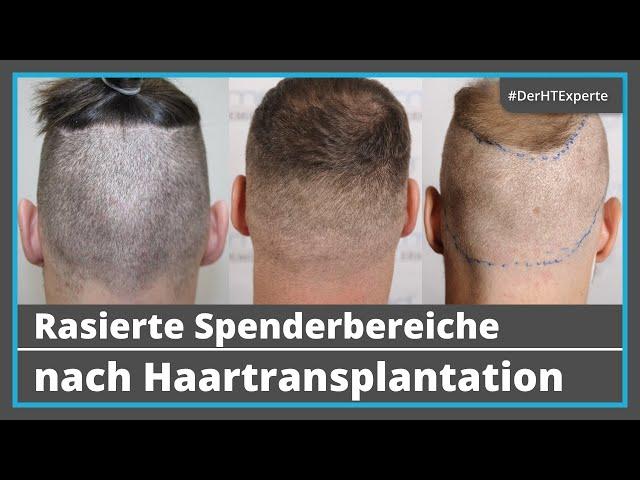 Nach Haartransplantation: Wie kurz kann man die Haare noch tragen? [10 rasierte Entnahmebereiche]