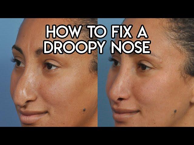 How to Fix a Droopy Nose