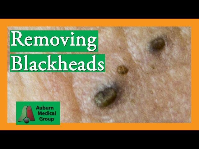 Several Blackheads | Auburn Medical Group