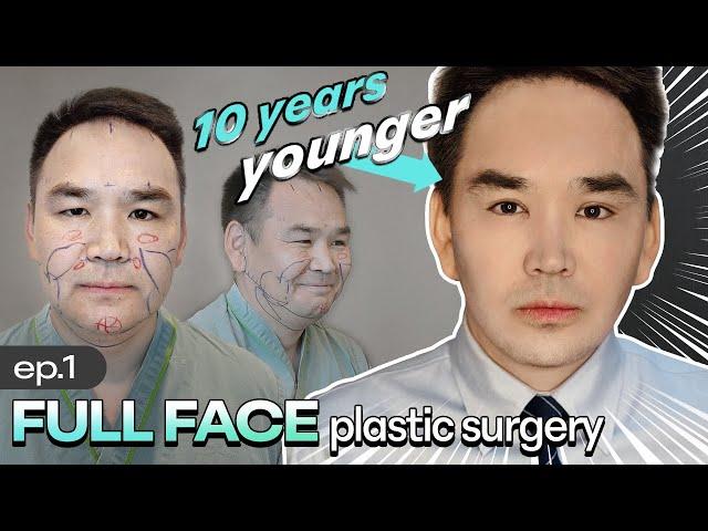 Mongolian Actor got face lift in KOREA│Male plastic surgery (PART 1)