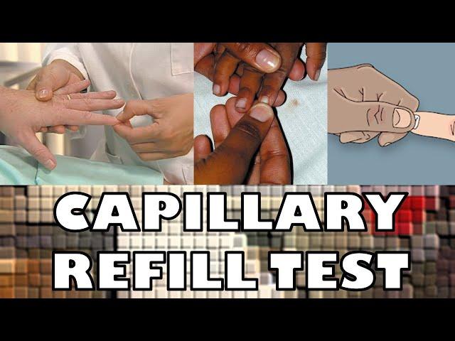 CAPILLARY REFILL TEST - FAST & SIMPLE - Ohio University - Human Anatomy & Physiology