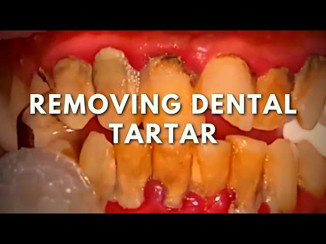 Dental tartar removal | Teeth cleaning procedure!