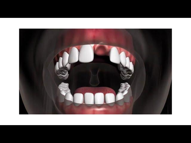 Dental Implant Animation