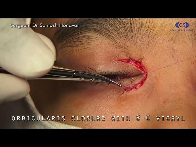 Blepharophimosis Correction Hornblas' CU plasty with Verwey's Lateral Canthoplasty