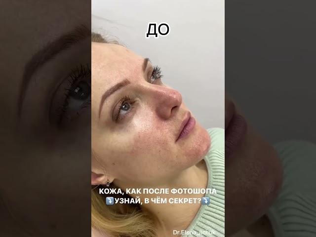 Фотоомоложение на аппарате М22: гладкая ровная кожа, как после фотошопа!
